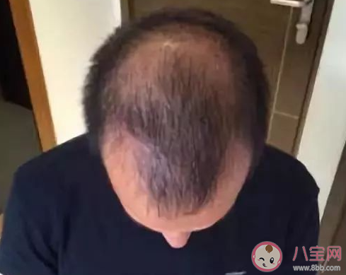 为什么年纪轻轻就脱发 怎样防止脱发 为什么年纪轻轻就脱发 怎样防止脱发