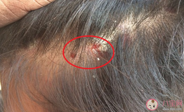 头皮上抠下的小颗粒是什么 如何正确护理头皮