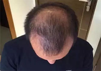 为什么年纪轻轻就脱发 怎样防止脱发