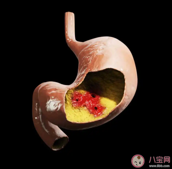 哪些职业人群更容易得胃病 哪些胃病有可能发展成胃癌