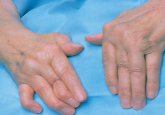 关节炎是冻出来的吗 风湿性关节炎怎么预防