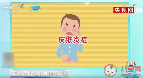 怎样辨别荨麻疹还是湿疹 荨麻疹和湿疹的病因是什么