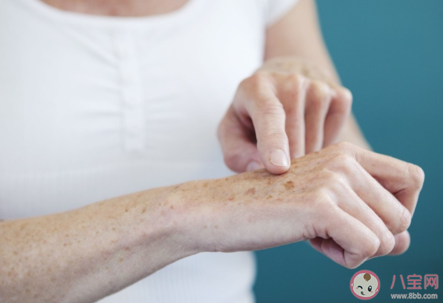 老年斑多大年纪的人长算正常 如何改善长斑的问题