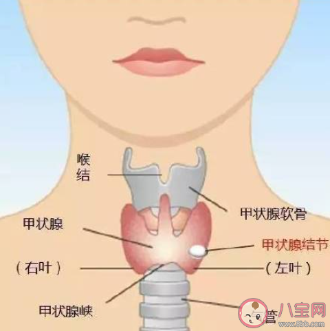 甲状腺结节生活上要注意什么 如何防止患甲状腺结节