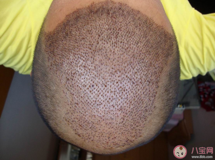 想要植发需要满足哪些条件 植发手术前要注意的事项