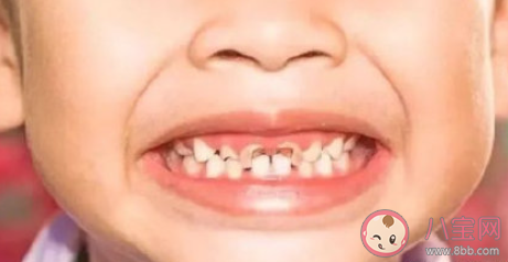 蛀牙真的和吃糖有关吗 如何防止蛀牙 蛀牙真的和吃糖有关吗 如何防止蛀牙