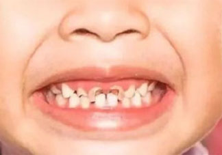 蛀牙真的和吃糖有关吗 如何防止蛀牙