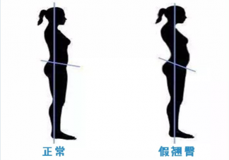 屁股真的越翘越好吗 如何矫正骨盆前倾
