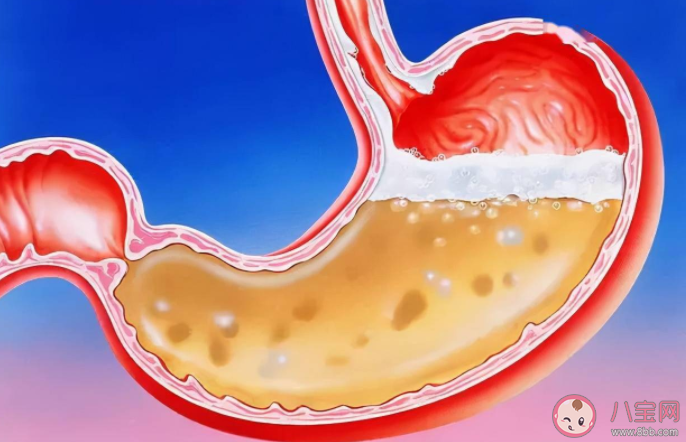 胃食管反流病为什么一停药就复发 如何预防胃食管反流复发