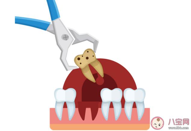 医生建议上午拔牙的原因是什么 哪几类人群拔牙一定要谨慎