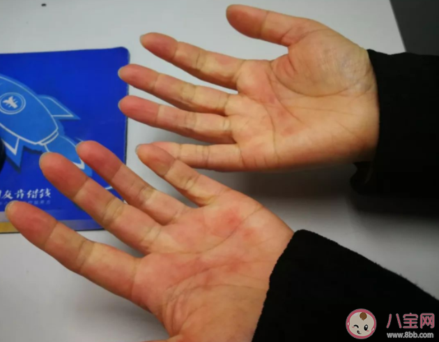 手指遇冷变紫怎么回事 手脚冰凉有哪些保暖小技巧 手指遇冷变紫怎么回事 手脚冰凉有哪些保暖小技巧