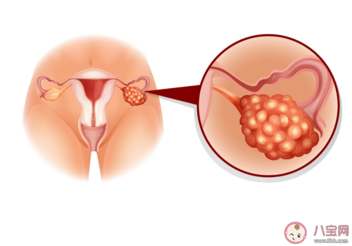 查出卵巢巧克力囊肿一定要手术吗 卵巢巧克力囊肿对生育危害有多大