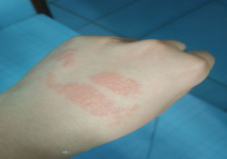 痒是一种痛觉吗 痛觉和痒觉在外周的感受器有什么区别