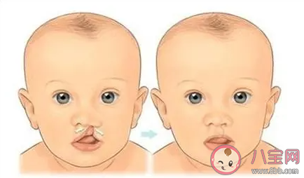 唇腭裂患儿刚做完手术可以吃哪一类食物 蚂蚁庄园12月3日答案介绍