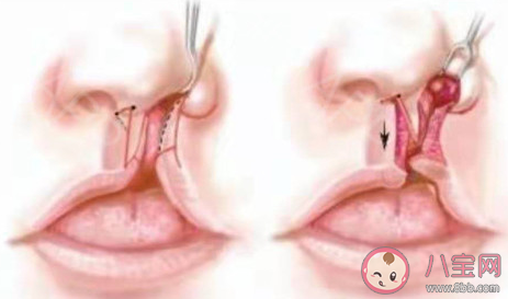 唇腭裂患儿刚做完手术可以吃哪一类食物 蚂蚁庄园12月3日答案介绍