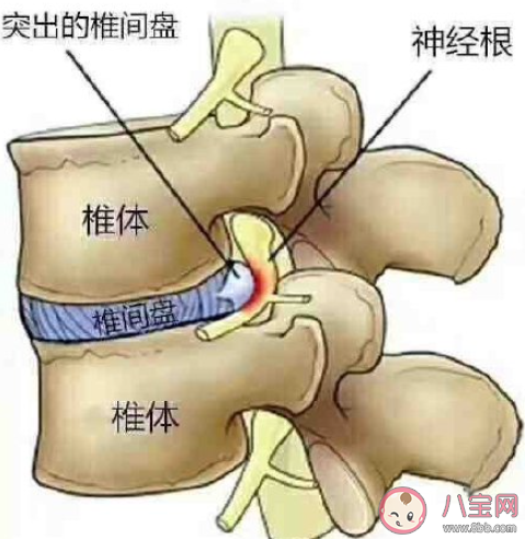 为什么坐久了会腰疼 久坐腰疼该如何缓解