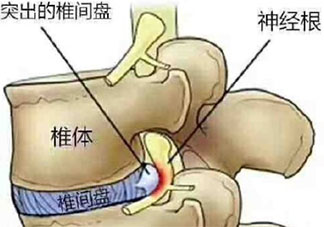 为什么坐久了会腰疼 久坐腰疼该如何缓解