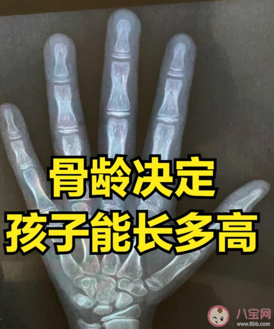 测骨龄为什么是左手手腕 骨龄检测中的辐射对孩子有害吗