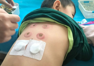 三九贴里都是什么药 贴三九贴要注意什么