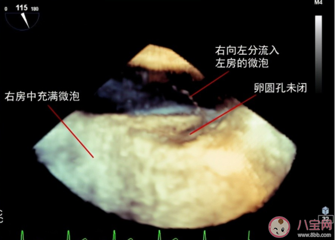 长期偏头痛要注意卵圆孔未闭 卵圆孔未闭需要手术吗