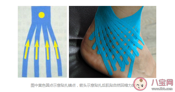 哪些情形可以用肌内效贴 肌贴到底应该怎么用
