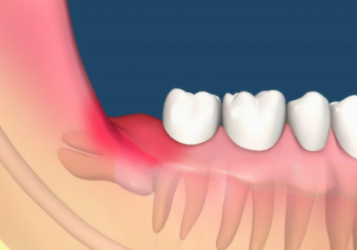 智齿是如何被拔出的 哪种智齿必须要拔