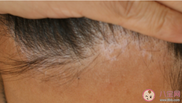 白癜风会导致头发变白吗 白癜风患者可以染发吗 白癜风会导致头发变白吗 白癜风患者可以染发吗