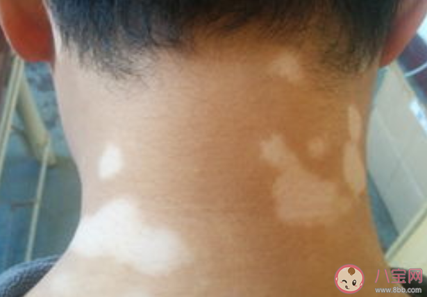 白癜风会导致头发变白吗 白癜风患者可以染发吗 白癜风会导致头发变白吗 白癜风患者可以染发吗