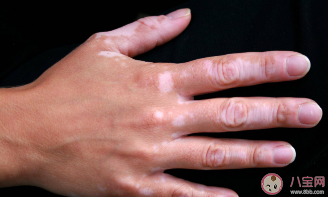 白癜风会导致头发变白吗 白癜风患者可以染发吗 白癜风会导致头发变白吗 白癜风患者可以染发吗