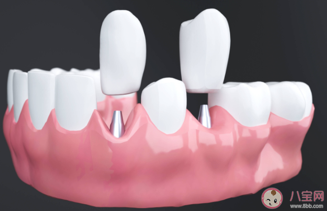 种植牙就要选最贵的吗 种植牙如何护理 种植牙就要选最贵的吗 种植牙如何护理