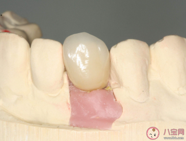 种植牙就要选最贵的吗 种植牙如何护理 种植牙就要选最贵的吗 种植牙如何护理