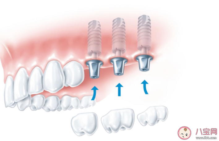 种植牙就要选最贵的吗 种植牙如何护理 种植牙就要选最贵的吗 种植牙如何护理