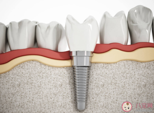 长期缺牙不种有什么危害 种植牙是缺几颗种几颗吗