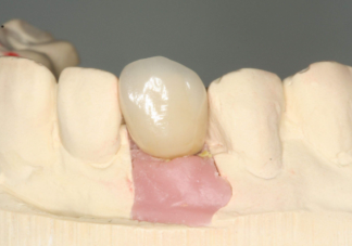 种植牙就要选最贵的吗 种植牙如何护理