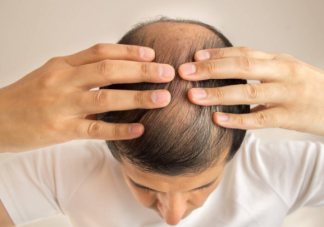每天掉多少头发是病理性脱发 这10种情况脱发会找上门