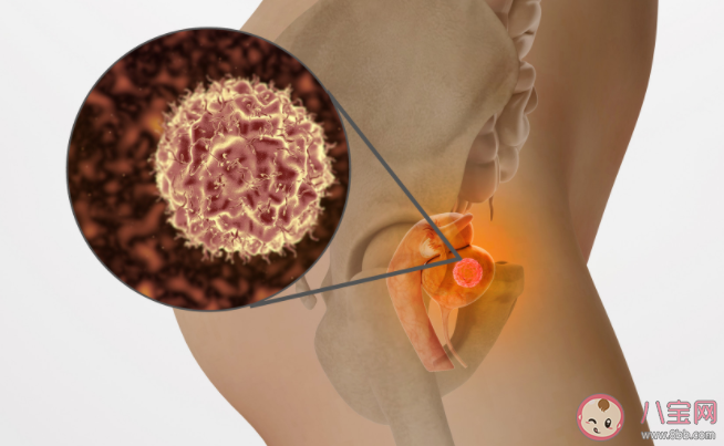 巧克力囊肿生孩子能治好吗 是先手术还是先备孕 巧克力囊肿生孩子能治好吗 是先手术还是先备孕