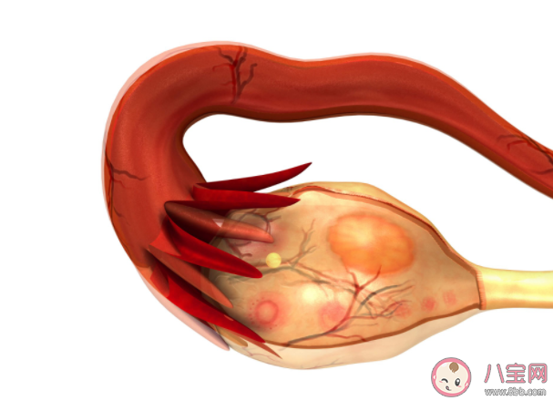 巧克力囊肿生孩子能治好吗 是先手术还是先备孕 巧克力囊肿生孩子能治好吗 是先手术还是先备孕