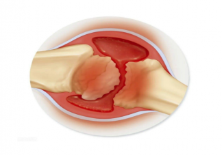 半月板手术后还能正常使用吗 半月板损伤能跑步吗