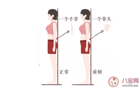 什么样的翘臀是骨盆前倾 造成骨盆前倾的原因是什么 什么样的翘臀是骨盆前倾 造成骨盆前倾的原因是什么