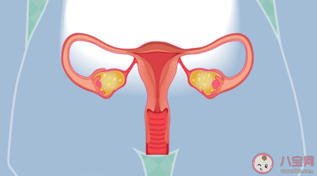 没结婚会得子宫内膜异位症吗 得了子宫内异症的人有哪些不适 没结婚会得子宫内膜异位症吗 得了子宫内异症的人有哪些不适