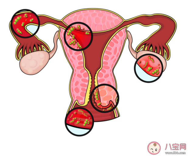 盆腔里的积液怎么排出来 盆腔积液是盆腔炎吗 盆腔里的积液怎么排出来 盆腔积液是盆腔炎吗