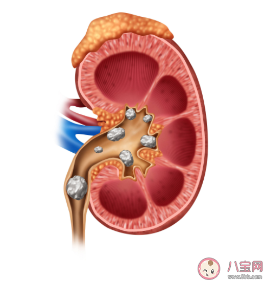 多喝可乐能溶解肾结石吗 生活中如何预防肾结石