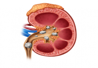 多喝可乐能溶解肾结石吗 生活中如何预防肾结石