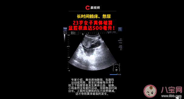 憋尿会导致黄体破裂吗 黄体破裂的原因有什么