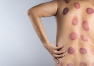 蚂蚁庄园拔罐后留下的印子越大说明效果越好吗 3月19日正确答案