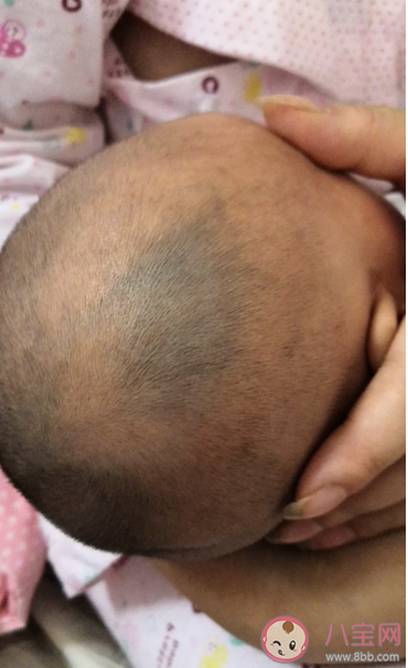 头被撞之后会起大包其他身体部位不会是因为什么 蚂蚁庄园3月24日正确答案