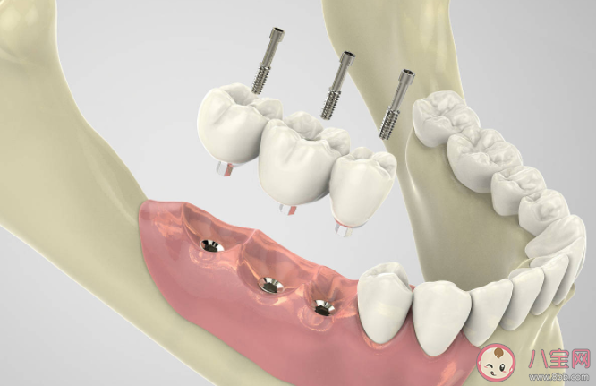 为什么种植牙费用这么高 种植牙的费用包括什么