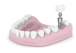 为什么种植牙费用这么高 种植牙的费用包括什么