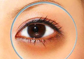 你会因为黑眼圈焦虑吗 有黑眼圈了该怎么办