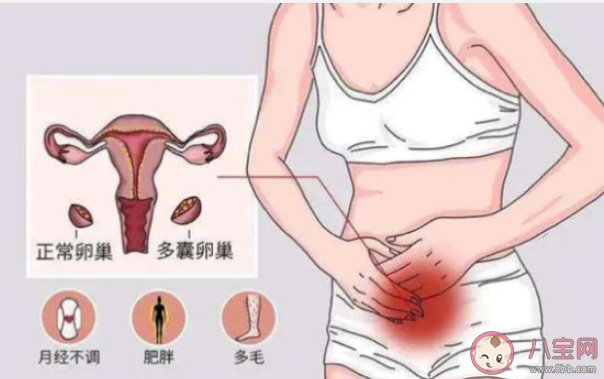 多囊卵巢综合症有多隐蔽 该如何应对多囊卵巢综合症